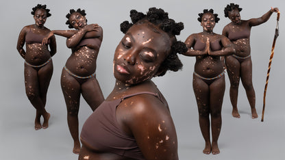 A group of five black women with dark skin and vitiligo, posed against a light gray studio background. The central figure is larger and in the foreground, while the others are smaller and arranged behind her.